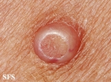 molluscum contagiosum