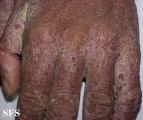 norwegian scabies