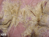 norwegian scabies