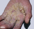 norwegian scabies