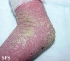 norwegian scabies