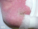 norwegian scabies