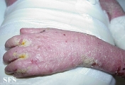 norwegian scabies