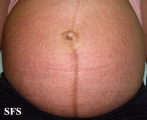 pruritic urticarial papules and plaques of pregnancy