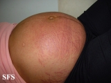 pruritic urticarial papules and plaques of pregnancy