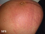 pruritic urticarial papules and plaques of pregnancy