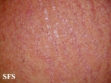 pruritic urticarial papules and plaques of pregnancy