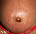 pruritic urticarial papules and plaques of pregnancy