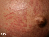 pruritic urticarial papules and plaques of pregnancy