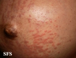 pruritic urticarial papules and plaques of pregnancy