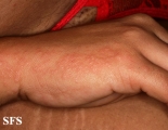 pruritic urticarial papules and plaques of pregnancy