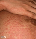 pruritic urticarial papules and plaques of pregnancy