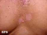 seborrhoeic dermatitis