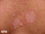 seborrhoeic dermatitis