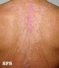 seborrhoeic dermatitis