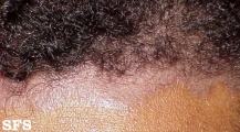 seborrhoeic dermatitis