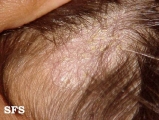 seborrhoeic dermatitis