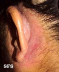 seborrhoeic dermatitis