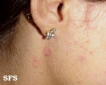 seborrhoeic dermatitis