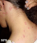 seborrhoeic dermatitis