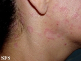 seborrhoeic dermatitis