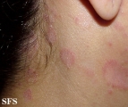 seborrhoeic dermatitis