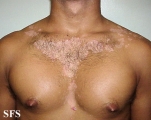 seborrhoeic dermatitis