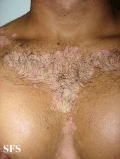 seborrhoeic dermatitis