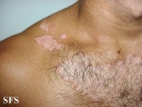 seborrhoeic dermatitis