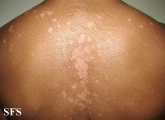 seborrhoeic dermatitis