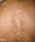 seborrhoeic dermatitis