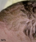 seborrhoeic dermatitis