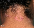 seborrhoeic dermatitis