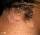 seborrhoeic dermatitis