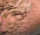 seborrhoeic dermatitis