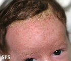 seborrhoeic dermatitis