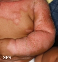 seborrhoeic dermatitis