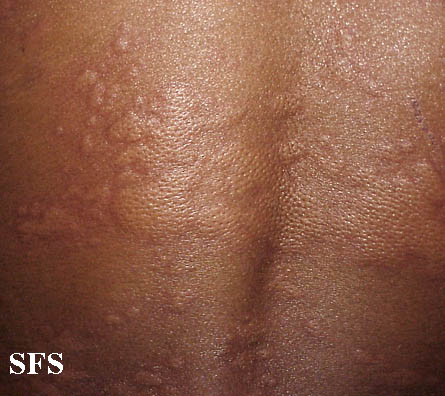 Patches and bumps on person's back.