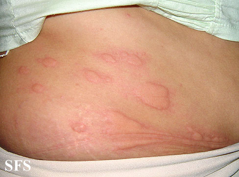 Raised swollen patches on person's skin.