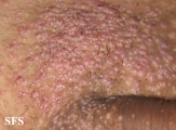 molluscum contagiosum