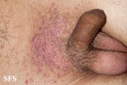 molluscum contagiosum