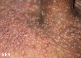 molluscum contagiosum