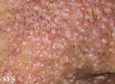 molluscum contagiosum