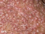 molluscum contagiosum