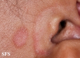 seborrhoeic dermatitis