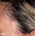 seborrhoeic dermatitis