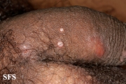 molluscum contagiosum