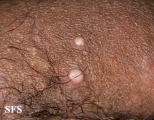 molluscum contagiosum