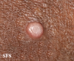 molluscum contagiosum