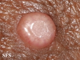 molluscum contagiosum